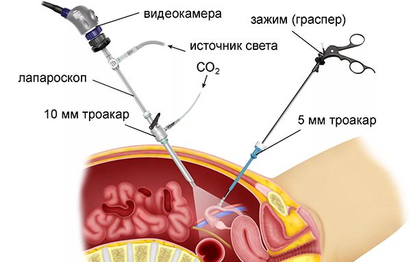 Хирургические методы лечения миомы матки