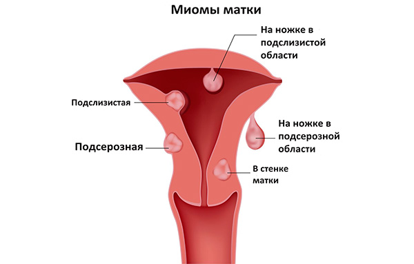 Причины возникновения миомы матки